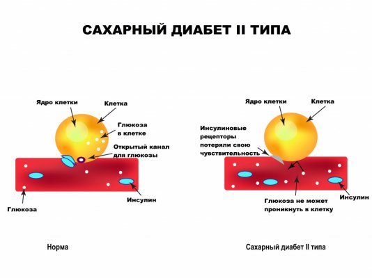 Левитра и диабет влияние на эректильную функцию